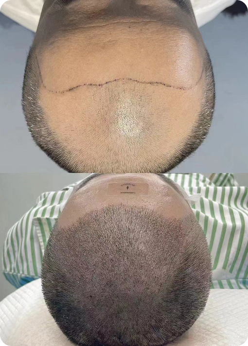 Natural eyebrow restoration without shaving - Healed results using AF technology